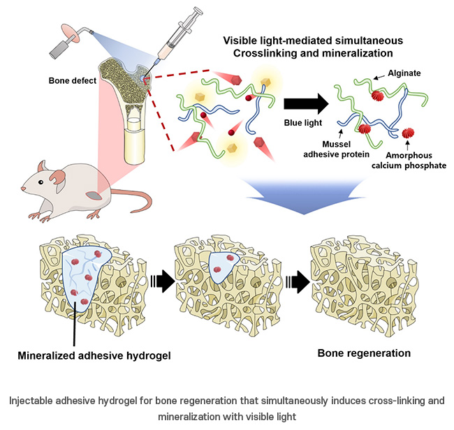 Injectable Hydrogel: A Breakthrough in Bone Healing and Regeneration